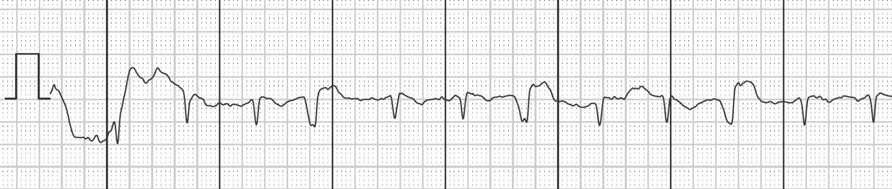 Illustration des vecteurs d'un ECG à 3 dérivations et des points d'attache possibles