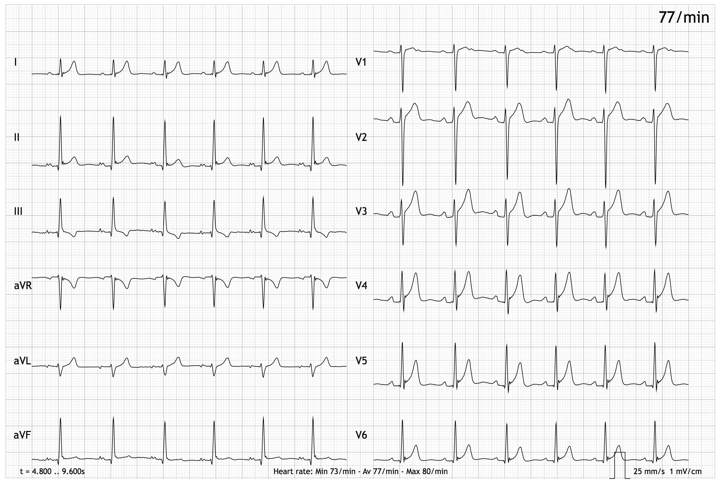 Graph der Ableitungen (I, II, III, aVR, aVL, aVF, V1-V6) eines EASI-EKGs