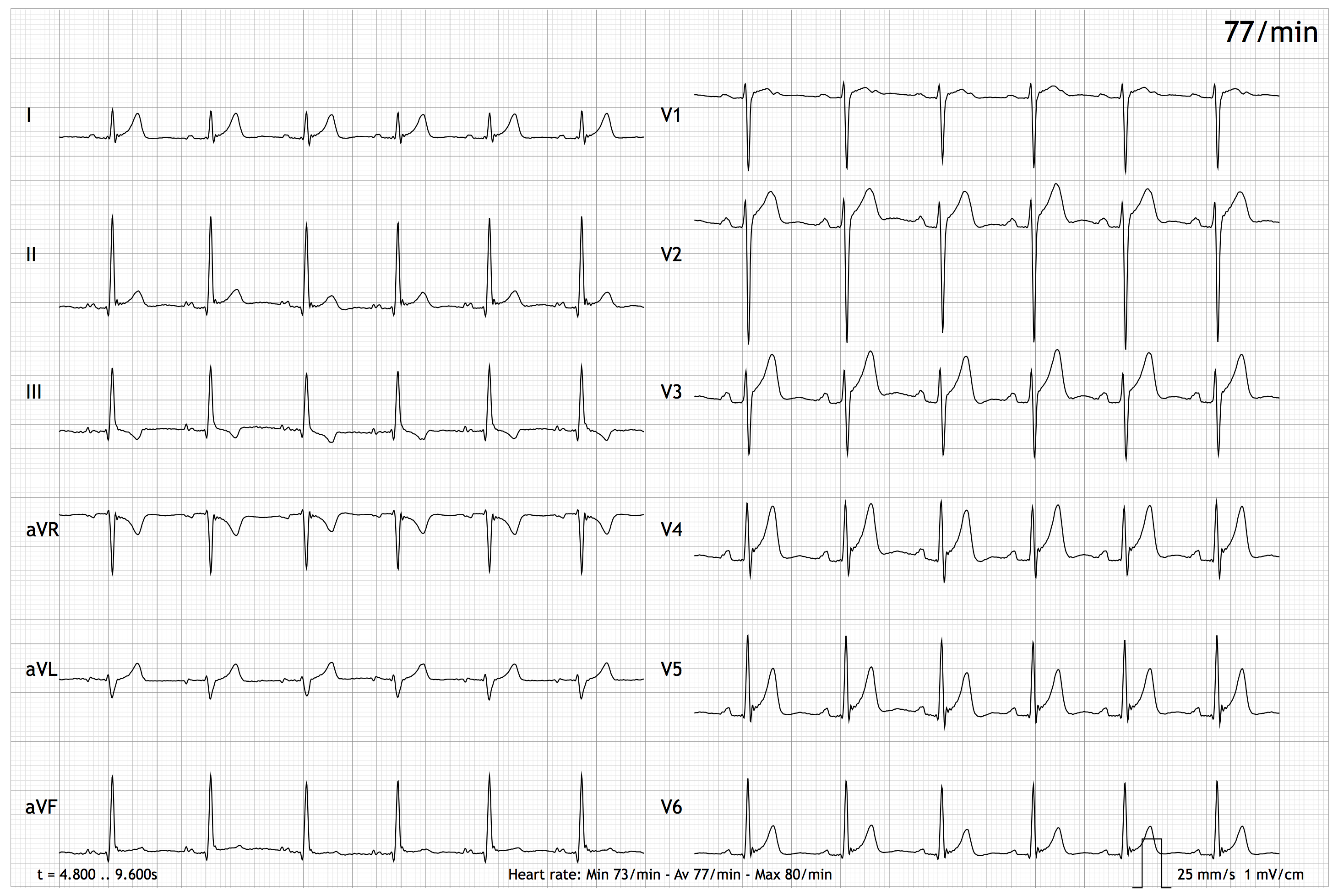 Graph showing the leads (I, II, III, aVR, aVL, aVF, V1-V6) of an EASI ECG