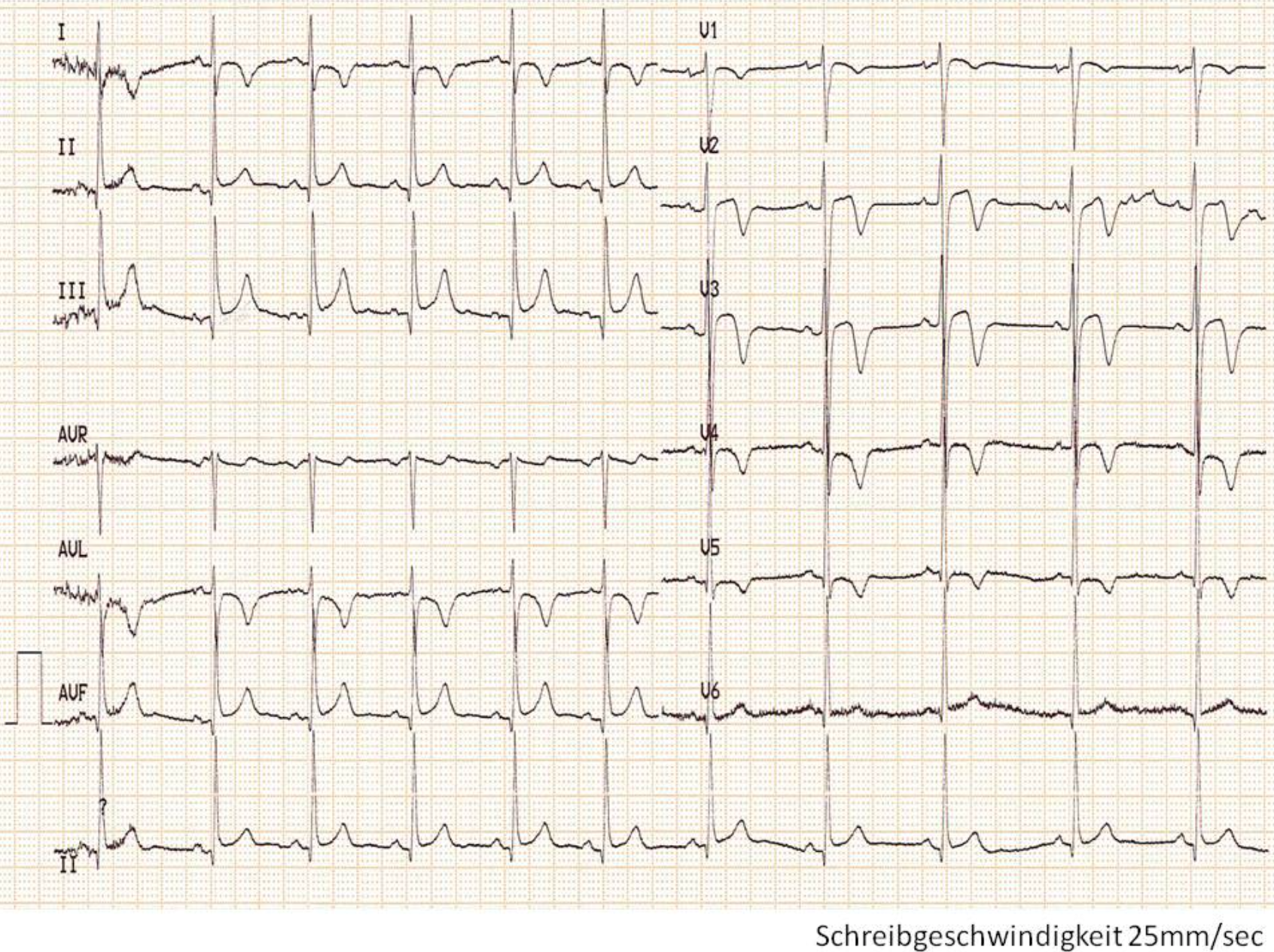 Graph der Ableitungen (I, II, III, aVR, aVL, aVF, V1-V6) eines 12-Kanal-EKGs 