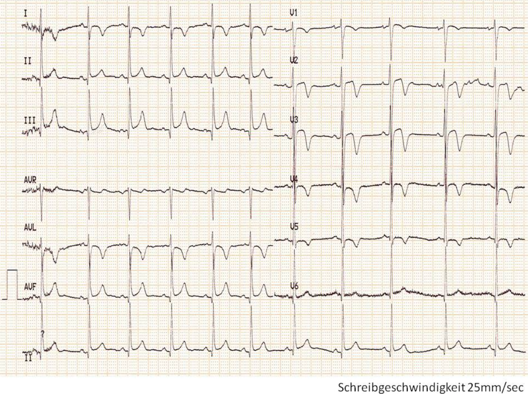 Graph showing the leads (I, II, III, aVR, aVL, aVF, V1-V6) of a 12-lead-ECG