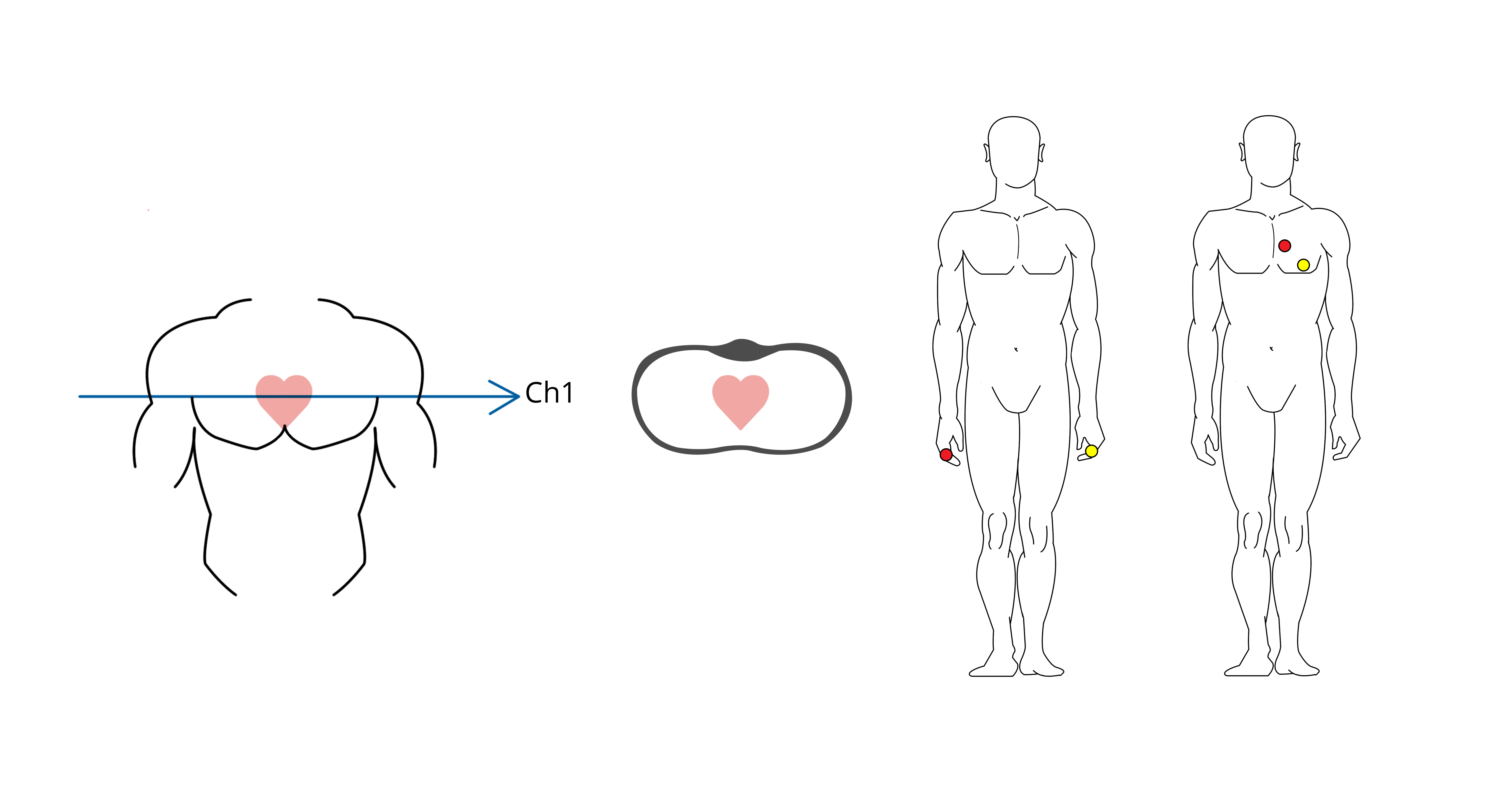 Illustration du vecteur spatial de la dérivation I d'un ECG à 1 dérivation et des points de fixation possibles