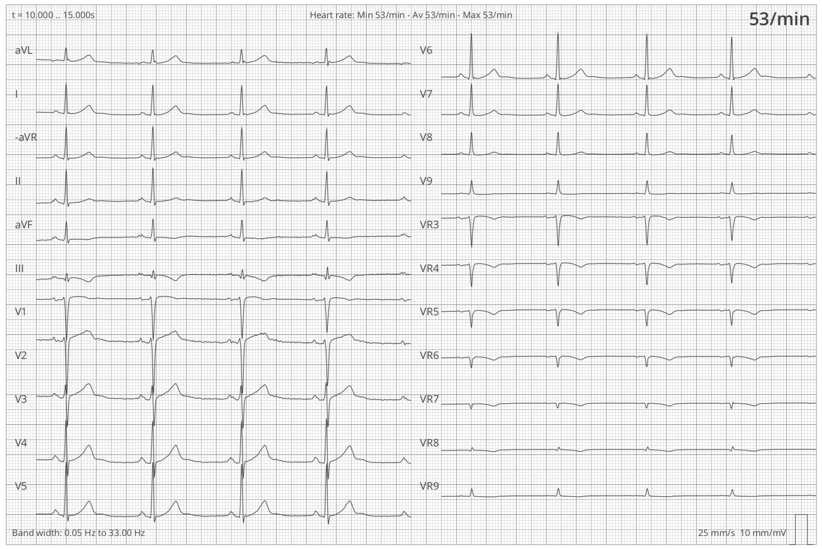 Graphique montrant les dérivations (I, II, III, aVR, aVL, aVF, V1-V9, VR2-VR9) d'un ECG 22 dérivations.