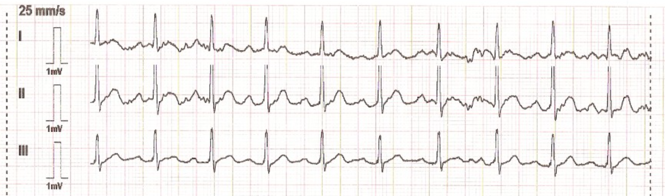 Graphique montrant les dérivations non spécifiées d'un ECG à 3 dérivations