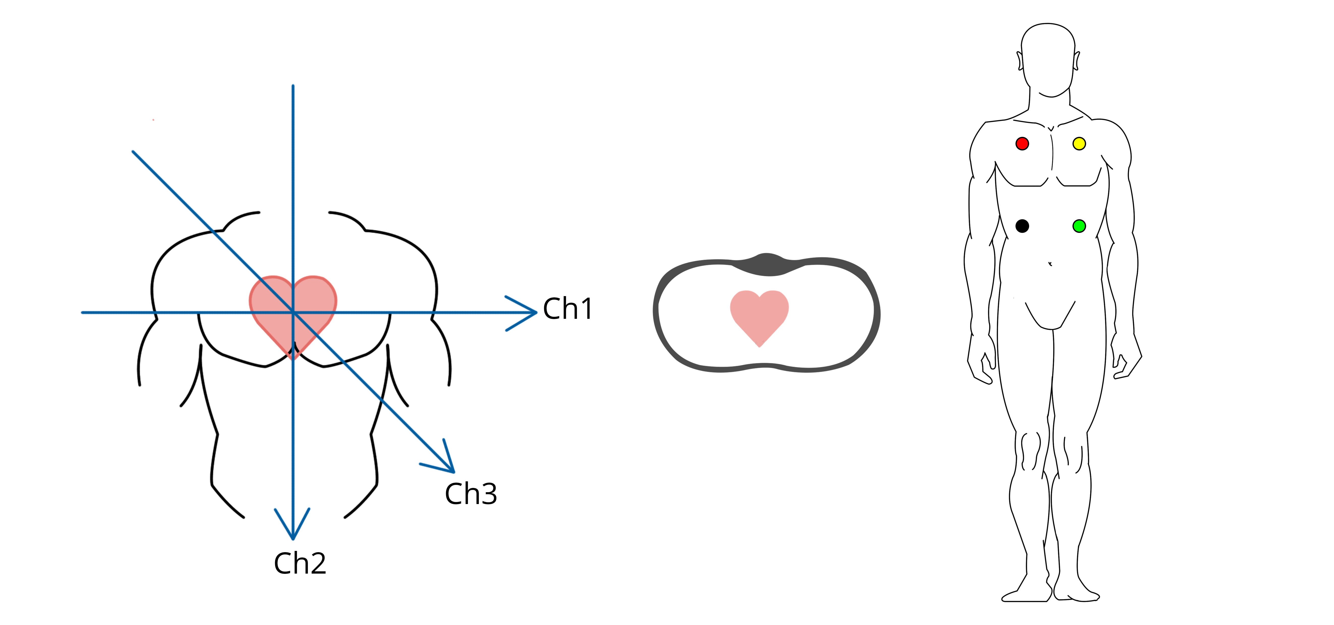 Darstellung der räumlichen Vektoren eines 3-Kanal-EKGs sowie möglicher Anlagepunkte