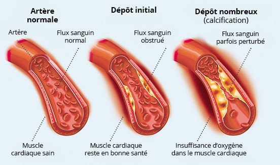 Crise cardiaque (infarctus du myocarde) - symptômes et ca ...