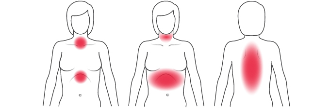 Illustration des symptômes courants crise cardiaque chez les femmes