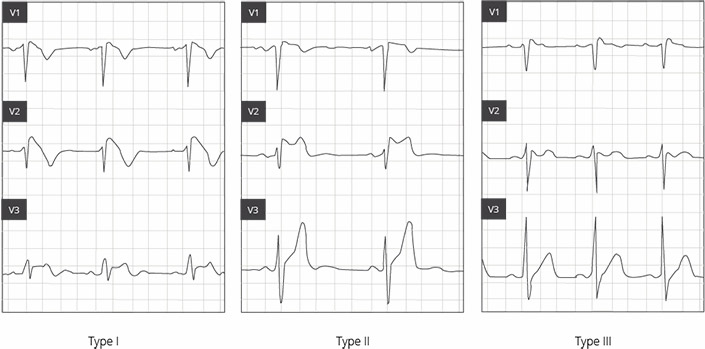 Brugada syndrome can be detected via an ECG Brugada syndrome: reliably diagnosed only by means of an ECG