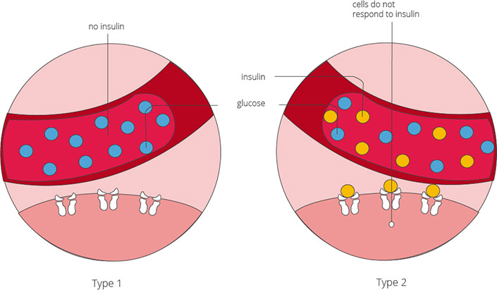Diabetes mellitus is divided into type 1 and 2 (with the exception of special types) The types of diabetes mellitus: type 1 and type 2