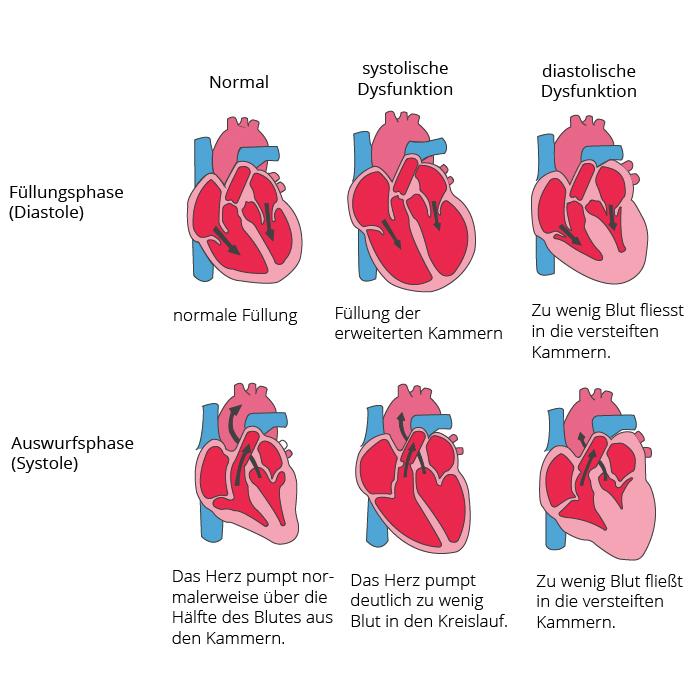 Grafische Darstellung eines gesunden Herzens im Vergleich mit systolischer Dysfunktion und diastolischer Dysfunktion 