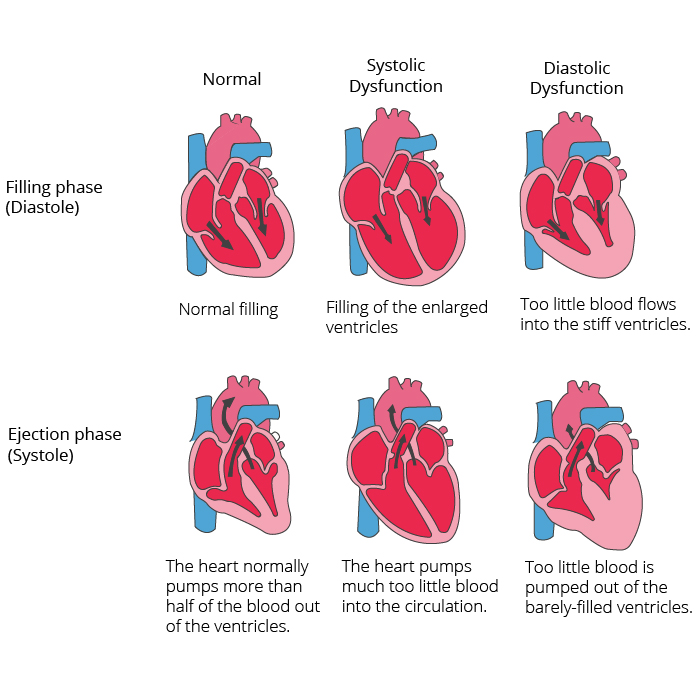 Cardiac Insufficiency Heart Failure Cardiosecur - 