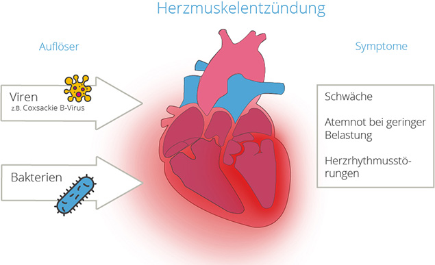 Viren und Bakterien: Die Auslöser für eine infektiöse Herzmuskelentzündung