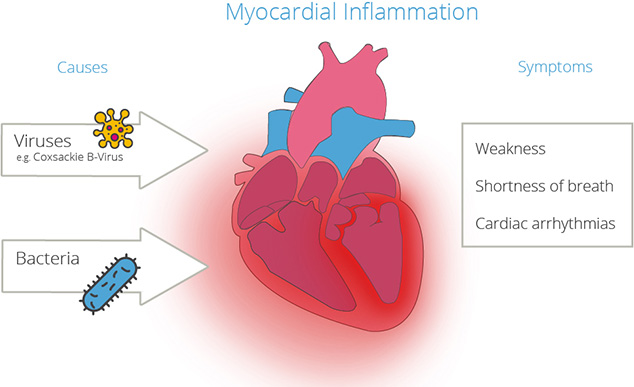 Viruses or bacteria can cause an infectious heart muscle inflammation Viruses and bacteria: the cause of infectious heart muscle inflammation
