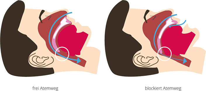 Obstruktive Schlafapnoe durch blockierte