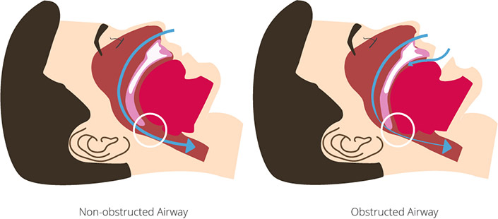 If the upper airway is blocked, this can lead to obstructive sleep apnea Obstructive sleep apnea due to obstructed airway