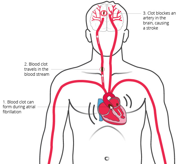 Stroke due to Atrial Fibrillation CardioSecur