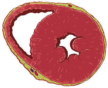 it is an increase in cardiac muscle mass when cardiac muscle fibers thicken