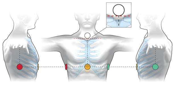 Diagram of the adhesive electrode attachment sites