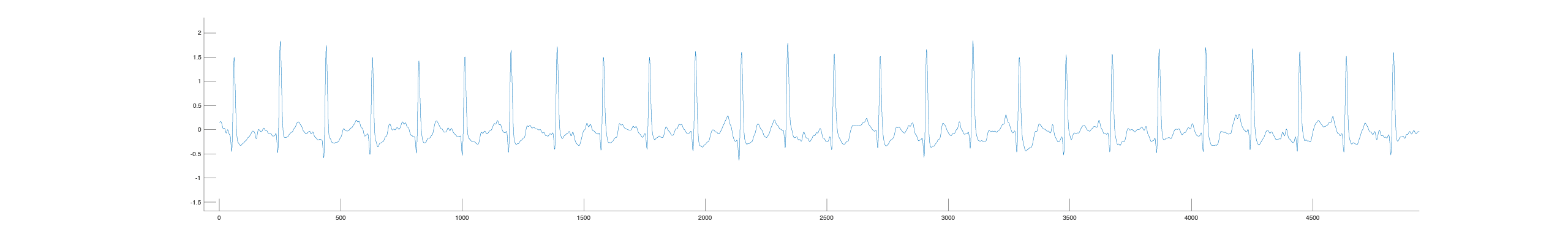 Illustration of steady sinus rhythm at 90 beats per minute