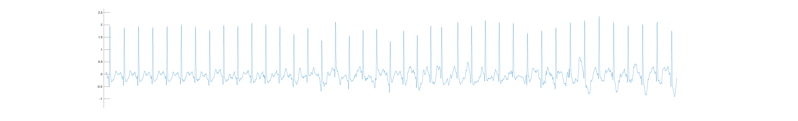 Illustration of non-pathological, frequency-related ST changes