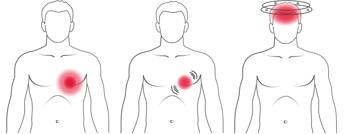 Erkennung von Herzrhythmusstörungen | CardioSecur