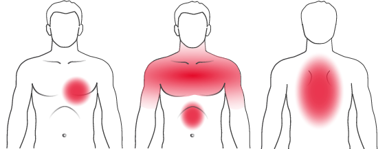 Abbildung Typische Symptome Herzinfarkt Frau