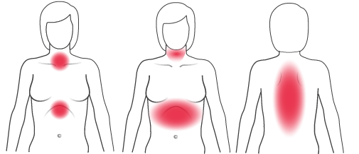 Graphic of typical heart attack symptoms for a woman