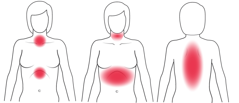 Darstellung typischer Herzinfarktsymptome bei Frauen