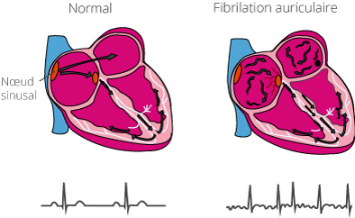 La fibrillation atriale - une maladie cardiaque courante | CardioSecur