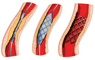 Ein Stent wird an der Engstelle platziert und unter hohem Druck gedehnt